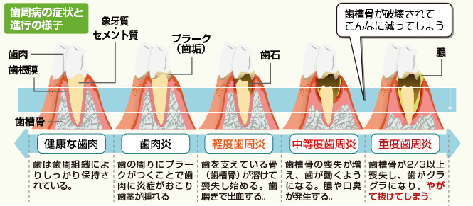 歯周病の症状と進行の様子